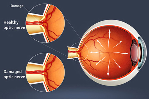 DAMAGED OPTIC NERVE CAUSE OF GLAUCOMA Vision SmartVision Smart