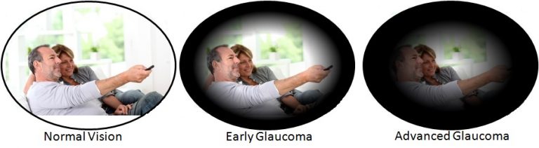 DAMAGED OPTIC NERVE CAUSE OF GLAUCOMA Vision SmartVision Smart